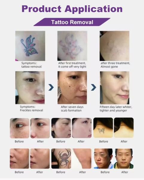 Laser Beauty Equipment Professional Pico Picosecond Machine Q Switched Nd Yag Laser Tattoo Removal Machine