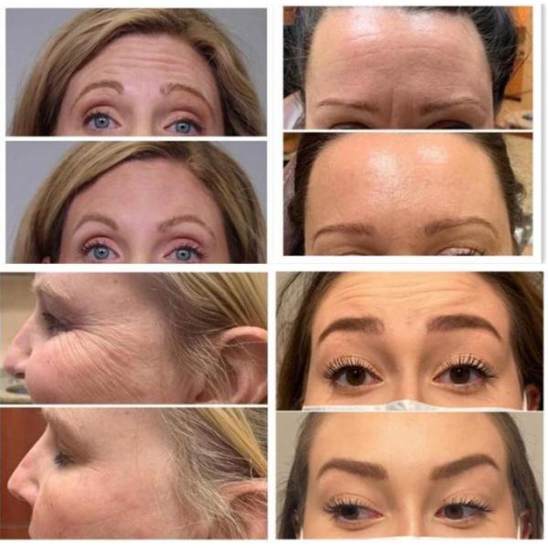 Botulinum Toxin 100IU Anti Wrinkles Powder Filler