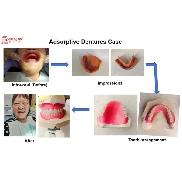 Customized Removable Dentures 3D Laser Printing CE Certified for Secure Fit
