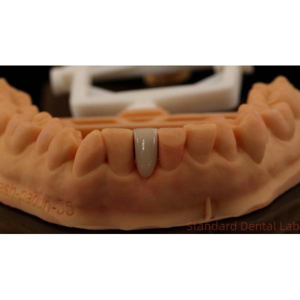Dental PFM Maryland Bridge High Esthetics FDA Certified With Vita Porcelian China Dental Lab
