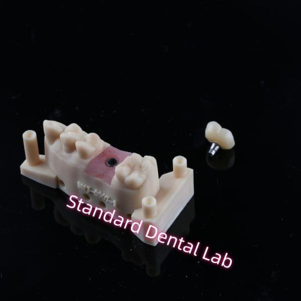 Coroa de implante de abutment personalizado de contorno completo de tornillo de zirconia retenido