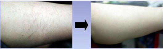 Semiconductor Laser Hair Removal Machine Skin Rejuvenation 600w 50 J/Cm2