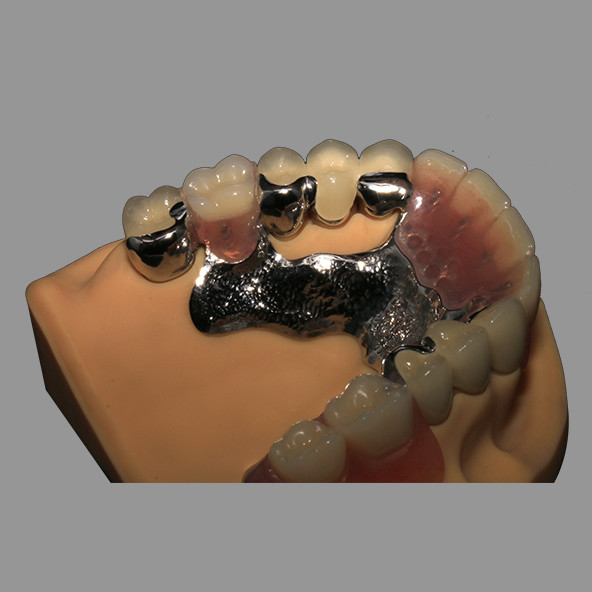 CoCr Acrylic Cast Metal Partial Combined With Fixed PFM