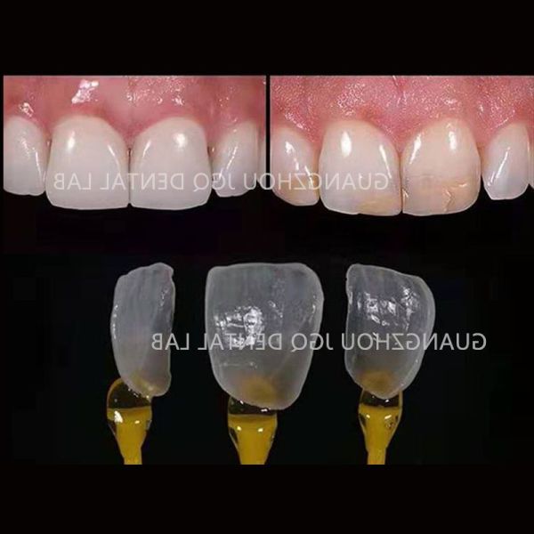 Tooth Like Shells Dental Porcelain Emax Veneers Dsd Design China Dental Lab