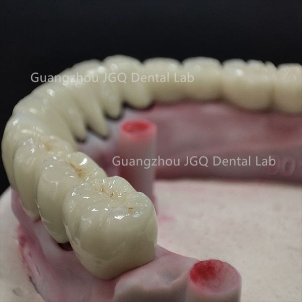 Porcelain Fused To Metal Pfm Crown Dentures Co-Cr Alloy / Titanium Structure Aesthetic