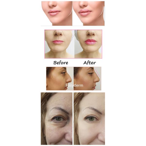 Продукт заботы кожи заполнителей губы Хялуроник кислоты Фосйдерм для пользы ручки Хялурон