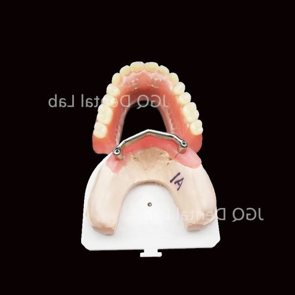 Customized Hybrid Dental Implants Hybrid Denture With Titanium Bar