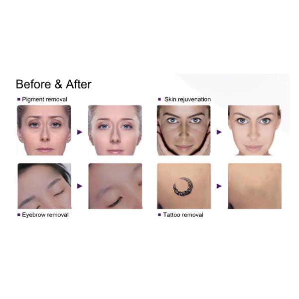 Professional Q Switch ND YAG Laser Machine Portable Laser Pigmentation Removal