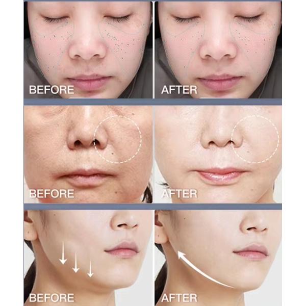 Гидра красота дермабразия микро пузырь лучший акне уход за кожей 8 в 1 лицевой аппарат