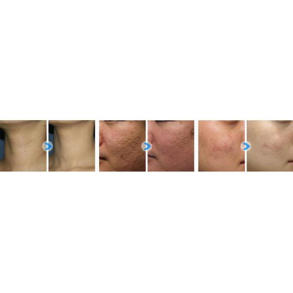 Hot Sale Portable Rf Skin Tightening Rf Fractional Micro Needle Beauty Machine