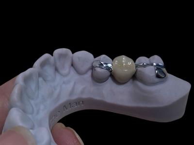 Accurate White Long Lasting Maryland Bridge Dental Customizable For Restoration