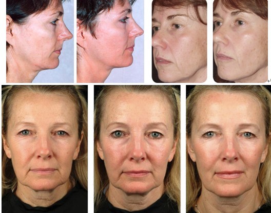 HOT SELLING!!! most effective RF thermage equipment for skin refreshing and rejuvenation