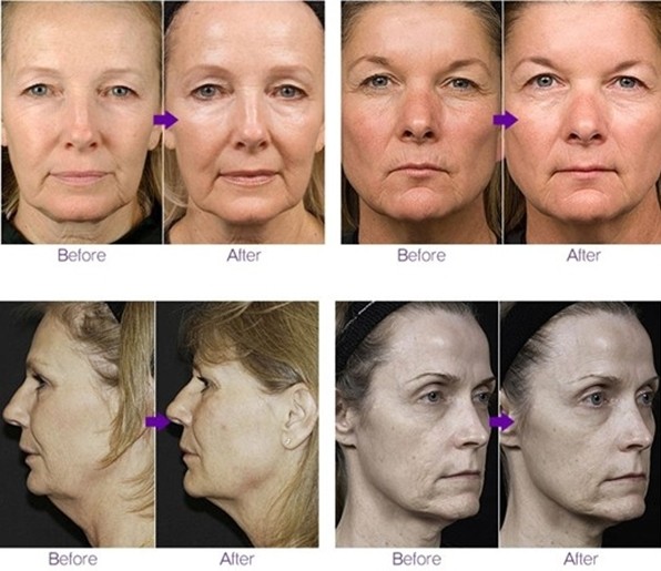 Perfect Beauty Salon Use Latest Fractional RF Micro Needle Thermal System