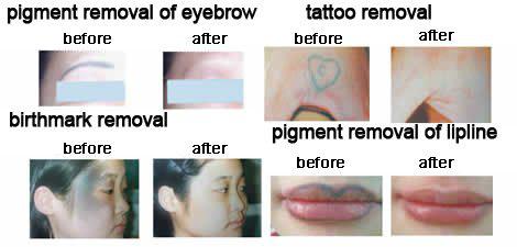 SHR Painless Hair Removal IPL Laser Machine , Yag Laser Tattoo Removal Machine