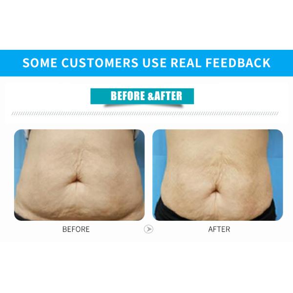 Home Use Mini Cryo Fat Freezing Weight Loss Equipment