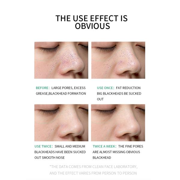 Ablande Lackhead derivó el suero del removedor de la espinilla del suero de la cara de la esencia