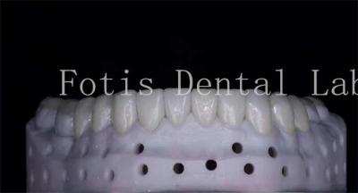OEM ODM Stain Resistant Natural Looking Porcelain Veneers High Strength