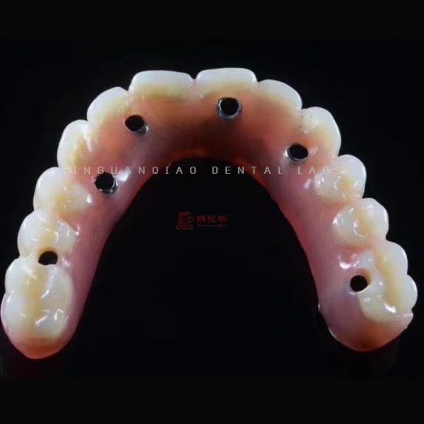 Snap in Implant Dentures Hybrid Dental Implant Restoration Screwed Retention for Dental Lab