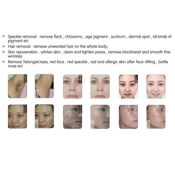 Permanent Hair Remove device SHR & IPL fda approved ipl