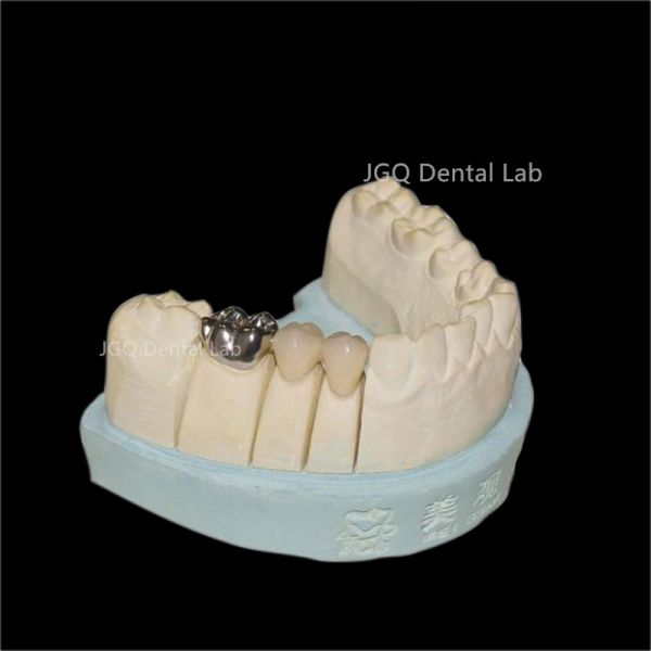 Porcelain Fused to Metal Crown and Bridge Made in China Dental Lab