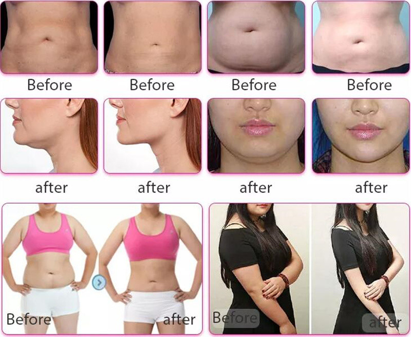 Потеря веса Cryolipolysis уменьшая липосакцию 80kpa машины жирную замерзая
