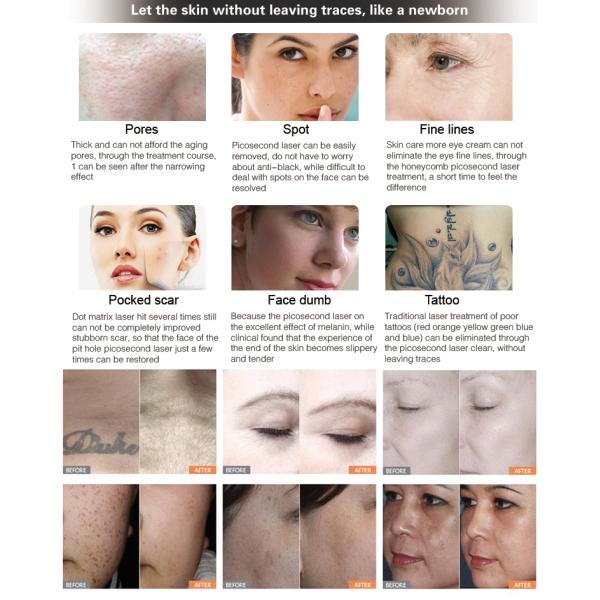 Вертикальная машина красоты лазера Picosure