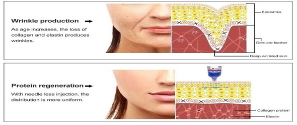 Профессиональная инъекция гиалуроновой кислоты, омолаживание кожи, мезотерапия