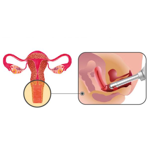 Multifunctional Co2 Vigina Tightening Device Continuous / Fractional Working Mode