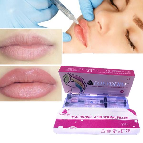 Enchimento dos lábios Aumento da plenitude dos lábios 2 ml Enchimento dérmico Fosyderm HA Injecção de enchimento