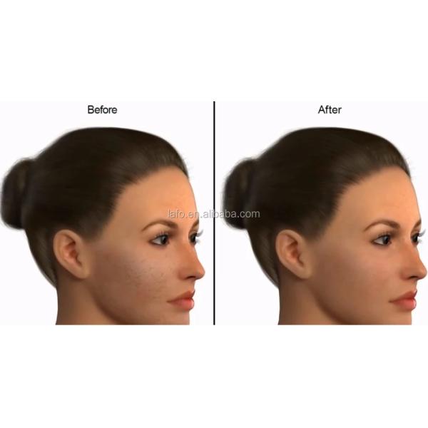 Dr pen M5 gold dermapen anti-aging derma roller pen microneedle therapy skin rejuvenation