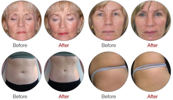 Анти- старея ледяная скульптура радиолокатора оборудования красоты РФ лицевая для удаления морщинки