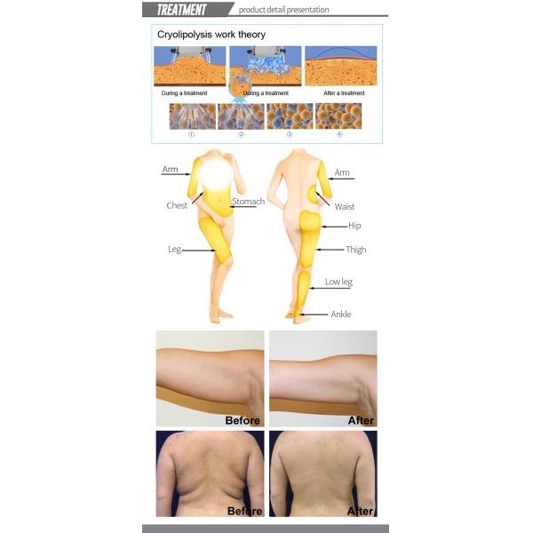 12 Inch Color LCD Touch Screen Cryo Body Slimming Machine for Chin Fat Freezing Treatment