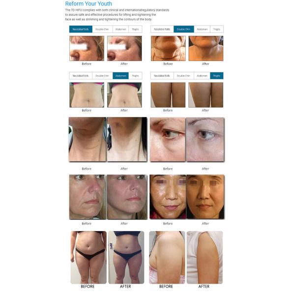Newest 7D Hifu Beauty Machine For Whitening, Wrinkle Removal Skin Rejuvenation