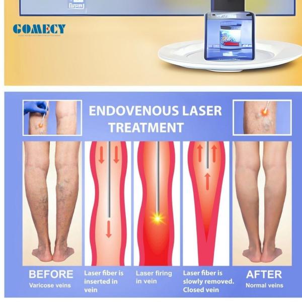 980+1470nm Laser Devices Mini Invasive Endovenous Laser Varicose Vein Surgery
