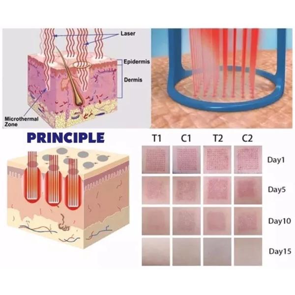 Частичный лазер СО2 подвергает волшебный ИМП ульс механической обработке для удаления шрама, затягивать кожи