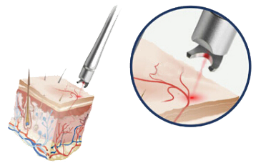 máquina vermelha do laser do vaso sanguíneo 980nm para remover o indolor vascular