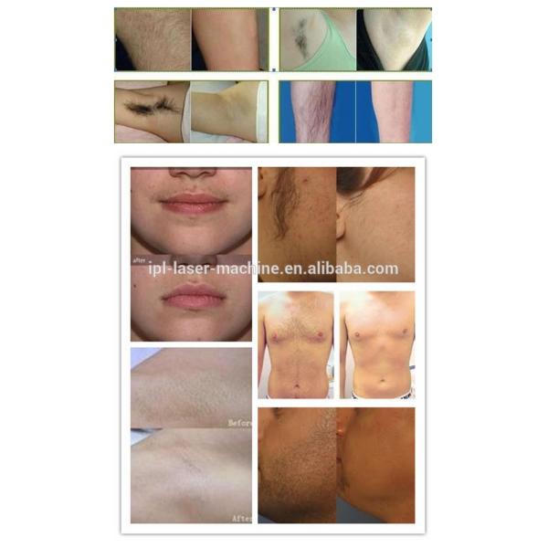 808nm diode laser hair removal machine on sale