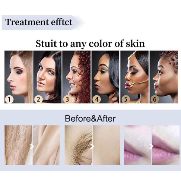 машина 755 удаления волос лазера диода платины льда сопрано 3000W 808 1064