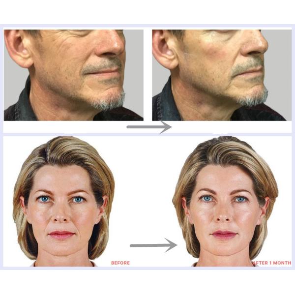 Заполнитель Juvederm Voluma впрыски щеки Chin соединенный крестом дермальный