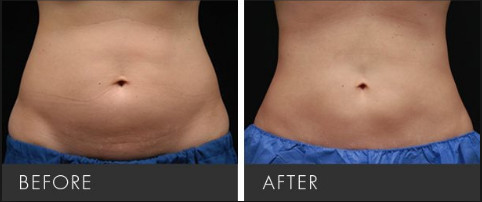 Non Surgical Liposuction Cryolipolysis Body Slimming Machine , Vacuum Weight Loss Machine