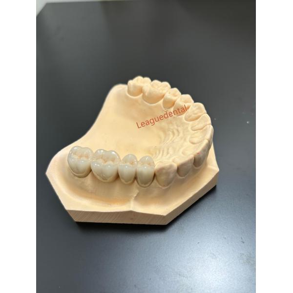 Stain Resistant Porcelain Fused To Metal Dental Compatibility PFM Crown