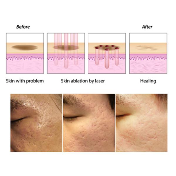 3 In 1 System CO2 Laser Beauty Equipment For  For Acne Scars Removal Safe