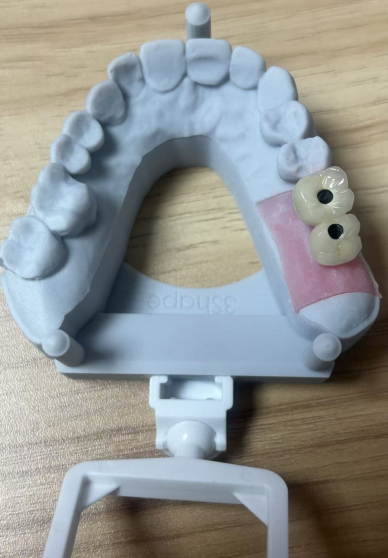 Implant-Supported Restorations