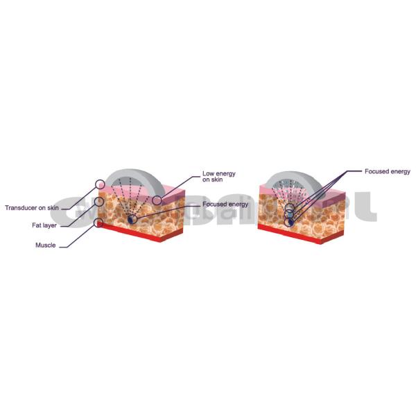 Skin tightening U Shape focused ultrasound slimming machine with CE Approved