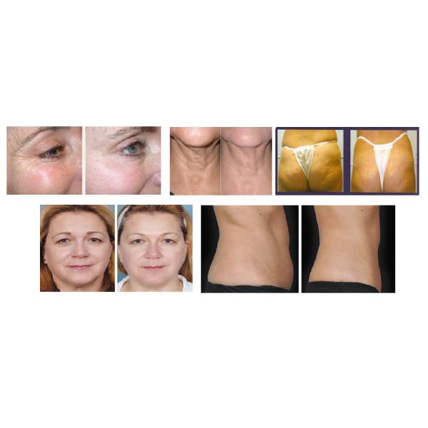 Hottest Slimming Body Vacuum Ultra Extra Cavitation RF Equipment