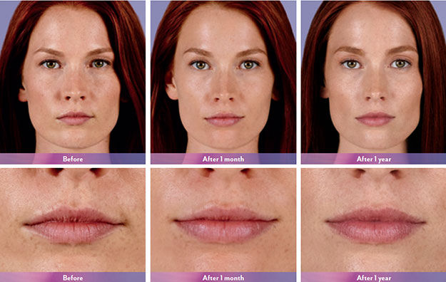 Перекрестно-связанный кожный наполнитель Juvederm 1x2 мл Juvederm Volbella Lip Filler 24 мг / мл