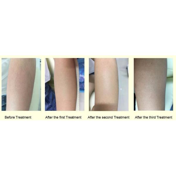 Painfree Laser Permanent Hair Removal Equipment 2000w Three Wavelength