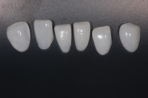 Emax Veneer Dental Veneer with Flexural Strength up to ~600MPa Seamlessly Blends with Natural Teeth and Mimics Natural Color