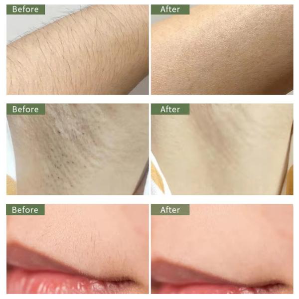 Les machines IPL portables pour éliminer les pores du corps et du visage