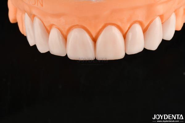 Ultra Thin IPS Emax Press Veneers Cosmetic Teeth Veneers For Anterior Posterior Restorations
